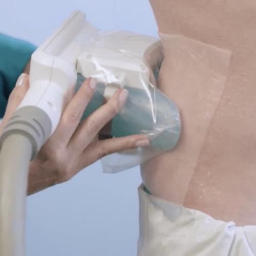 Coolsculpting Treatment & Other Fat Loss Solutions: Is Permanent Fat Loss for You?, AgeRejuvenation in Tampa Bay and Central Florida