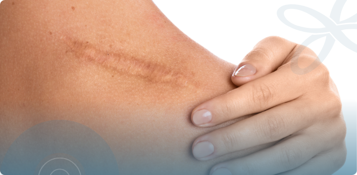 Professional Scar Reduction Near Orlando: Treatments for Post-Acne Texture, AgeRejuvenation in Tampa Bay and Central Florida